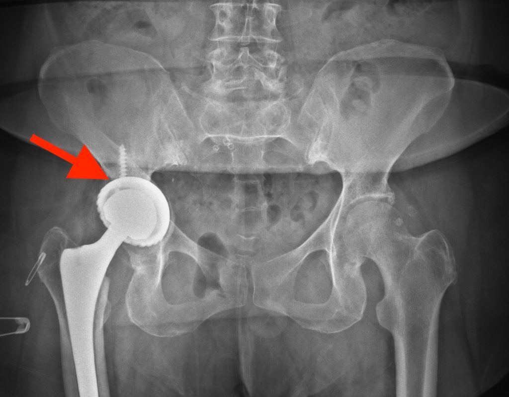 Revizyon kalça protezi öncesi asetabular komponent gevşeme grafisi